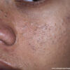 Acne vulgar.Observe os comedões