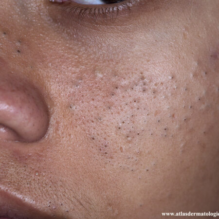 Acne vulgar.Observe os comedões