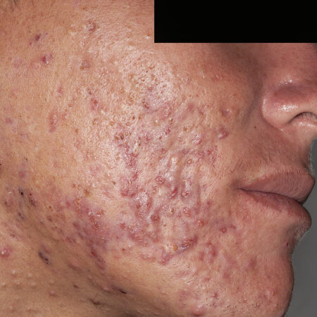 Acne Vulgar