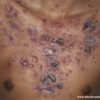 Acne fulminans