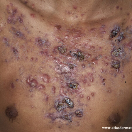 Acne fulminans