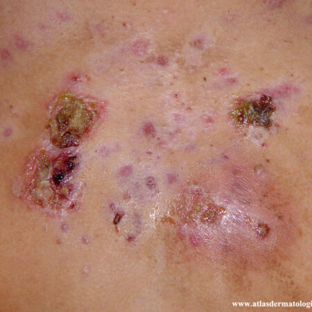 Acne Fulminans