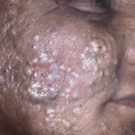 Cloracne